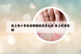 身上有十多處皮膚癬應(yīng)該怎么辦 身上好多處癬