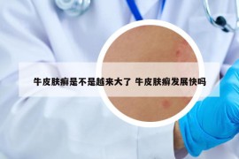牛皮膚癬是不是越來大了 牛皮膚癬發(fā)展快嗎