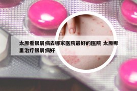 太原看銀屑病去哪家醫(yī)院最好的醫(yī)院 太原哪里治療銀屑病好