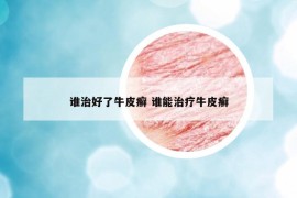 誰(shuí)治好了牛皮癬 誰(shuí)能治療牛皮癬