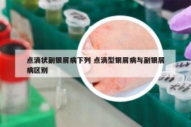 點(diǎn)滴狀副銀屑病下列 點(diǎn)滴型銀屑病與副銀屑病區(qū)別
