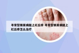 尋常型銀屑病腿上紅丘疹 尋常型銀屑病腿上紅丘疹怎么治療