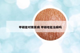 甲硝銼對銀屑病 甲硝唑能治癬嗎