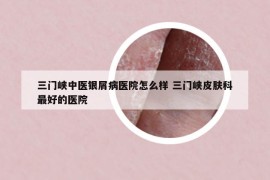 三門峽中醫(yī)銀屑病醫(yī)院怎么樣 三門峽皮膚科最好的醫(yī)院