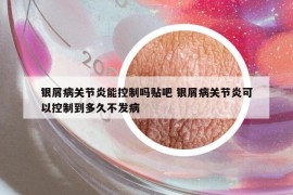 銀屑病關(guān)節(jié)炎能控制嗎貼吧 銀屑病關(guān)節(jié)炎可以控制到多久不發(fā)病