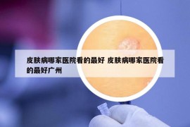 皮膚病哪家醫(yī)院看的最好 皮膚病哪家醫(yī)院看的最好廣州