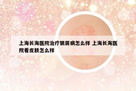 上海長海醫(yī)院治療銀屑病怎么樣 上海長海醫(yī)院看皮膚怎么樣