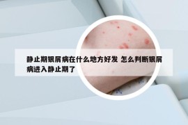 靜止期銀屑病在什么地方好發(fā) 怎么判斷銀屑病進入靜止期了