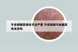 牛皮癬糖尿病會(huì)不會(huì)嚴(yán)重 牛皮膚癬與血糖高有關(guān)系嗎