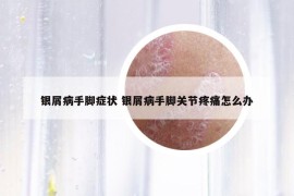 銀屑病手腳癥狀 銀屑病手腳關節(jié)疼痛怎么辦