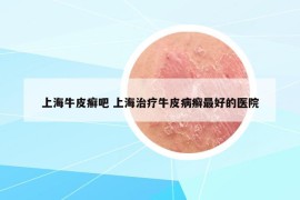 上海牛皮癬吧 上海治療牛皮病癬最好的醫(yī)院