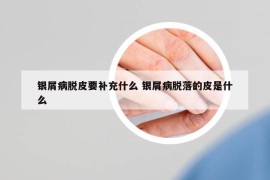 銀屑病脫皮要補充什么 銀屑病脫落的皮是什么