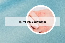 得了牛皮癬可以吃蛋糕嗎