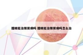 醋精能治銀屑病嗎 醋精能治銀屑病嗎怎么治