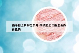 孩子臉上長癬怎么辦 孩子臉上長癬怎么辦 白色的