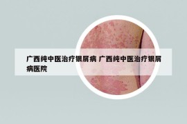 廣西純中醫(yī)治療銀屑病 廣西純中醫(yī)治療銀屑病醫(yī)院