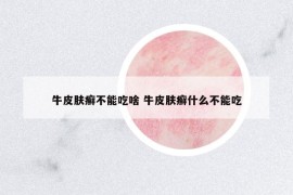牛皮膚癬不能吃啥 牛皮膚癬什么不能吃