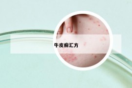 牛皮癬匯方