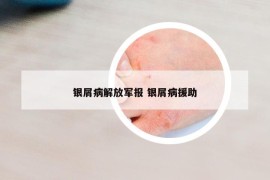 銀屑病解放軍報(bào) 銀屑病援助
