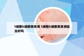 t細(xì)胞b細(xì)胞銀屑病 t細(xì)胞b細(xì)胞銀屑病能治好嗎