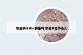 銀屑病給別人傳染嗎 銀屑病能傳染么