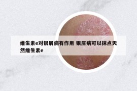 維生素e對銀屑病有作用 銀屑病可以抹點天然維生素e