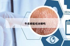 牛皮癬能吃冰糖嗎