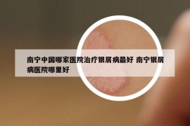南寧中國(guó)哪家醫(yī)院治療銀屑病最好 南寧銀屑病醫(yī)院哪里好