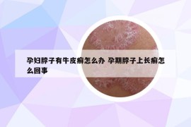 孕婦脖子有牛皮癬怎么辦 孕期脖子上長癬怎么回事