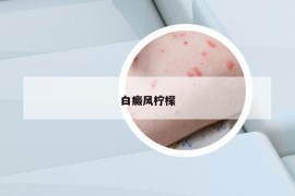 白癜風(fēng)檸檬