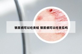 銀屑病可以吃青蛙 銀屑病可以吃青瓜嗎
