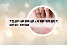 真菌感染的銀屑病的要從哪里找 銀屑病與真菌感染的關(guān)系綜述