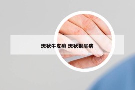 斑狀牛皮癬 斑狀銀屑病
