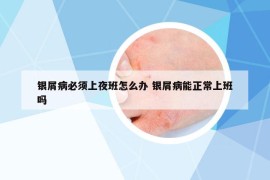 銀屑病必須上夜班怎么辦 銀屑病能正常上班嗎
