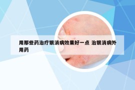 用那些藥治療銀消病效果好一點(diǎn) 治銀消病外用藥