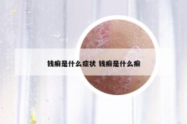 錢癬是什么癥狀 錢癬是什么癬