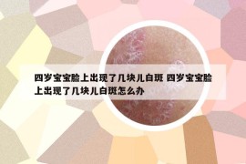 四歲寶寶臉上出現(xiàn)了幾塊兒白斑 四歲寶寶臉上出現(xiàn)了幾塊兒白斑怎么辦