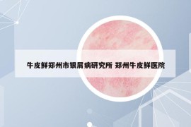 牛皮鮮鄭州市銀屑病研究所 鄭州牛皮鮮醫(yī)院