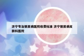 濟(jì)寧專治銀屑病醫(yī)院收費(fèi)標(biāo)準(zhǔn) 濟(jì)寧銀屑病皮膚科醫(yī)院
