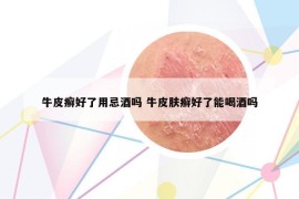 牛皮癬好了用忌酒嗎 牛皮膚癬好了能喝酒嗎
