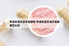 甲潑尼龍片治牛皮癬嗎 甲潑尼龍片治療皮膚病怎么樣
