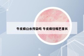牛皮癬口水傳染嗎 牛皮癬往嘴巴里長