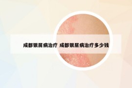 成都銀屑病治療 成都銀屑病治療多少錢