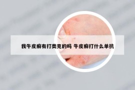 我牛皮癬有打類克的嗎 牛皮癬打什么單抗