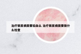 治療銀屑病需要驗(yàn)血么 治療銀屑病需要做什么檢查