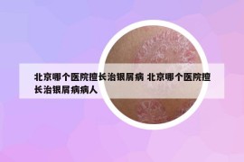 北京哪個(gè)醫(yī)院擅長(zhǎng)治銀屑病 北京哪個(gè)醫(yī)院擅長(zhǎng)治銀屑病病人