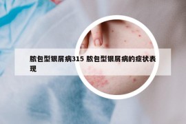 膿包型銀屑病315 膿包型銀屑病的癥狀表現(xiàn)