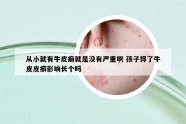 從小就有牛皮癬就是沒有嚴(yán)重啊 孩子得了牛皮皮癬影響長個(gè)嗎