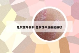 急發(fā)性牛皮癬 急發(fā)性牛皮癬的癥狀