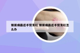 銀屑病最近手臂發(fā)紅 銀屑病最近手臂發(fā)紅怎么辦